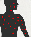 Image depicting varicella (chickenpox)