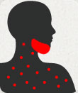 Image depicting mumps